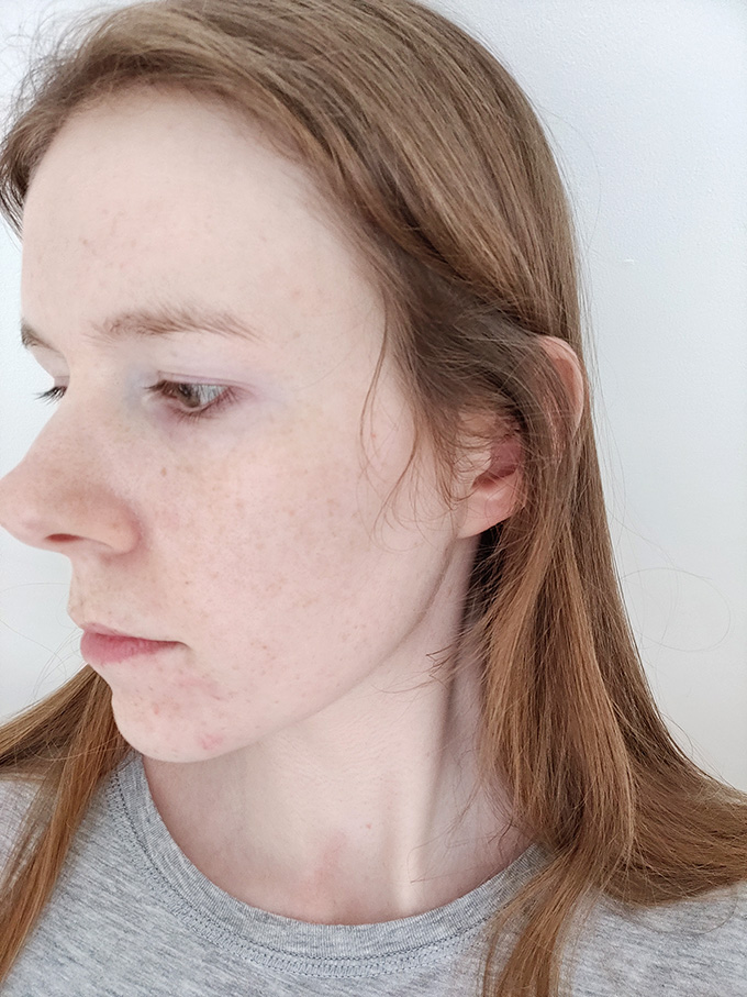 My Experience With Acne On The Contraceptive Pill {Both Combined and POP} | Annie's Noms